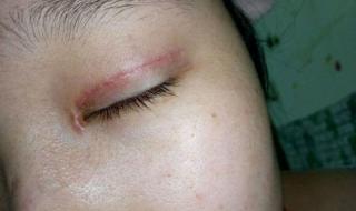 双眼皮贴怎么贴 双眼皮贴怎么贴